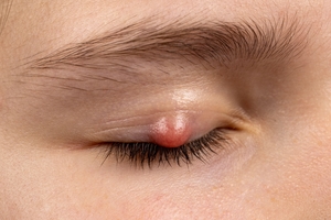 Chalazion on a child's eye.