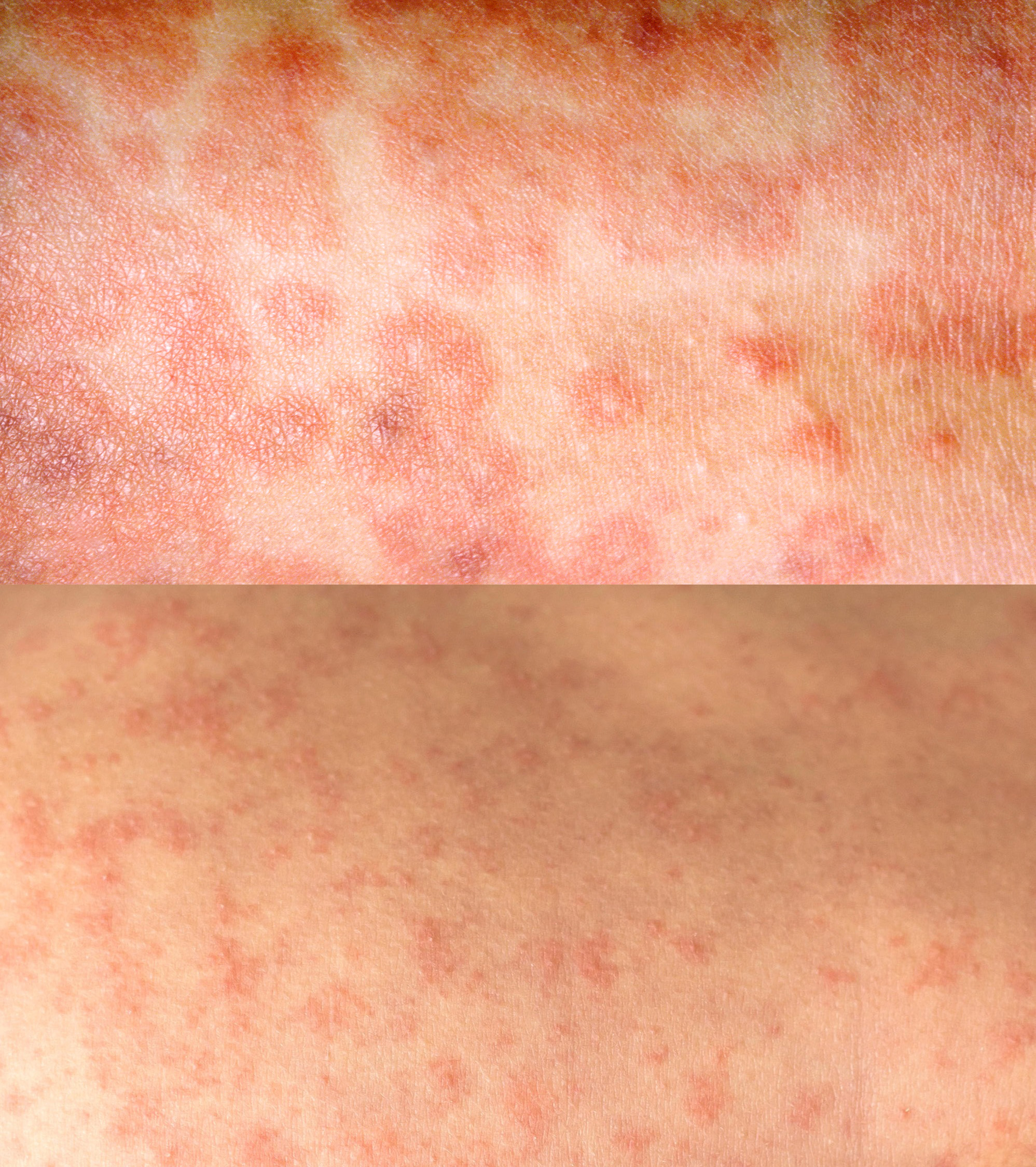 Image of measles rash