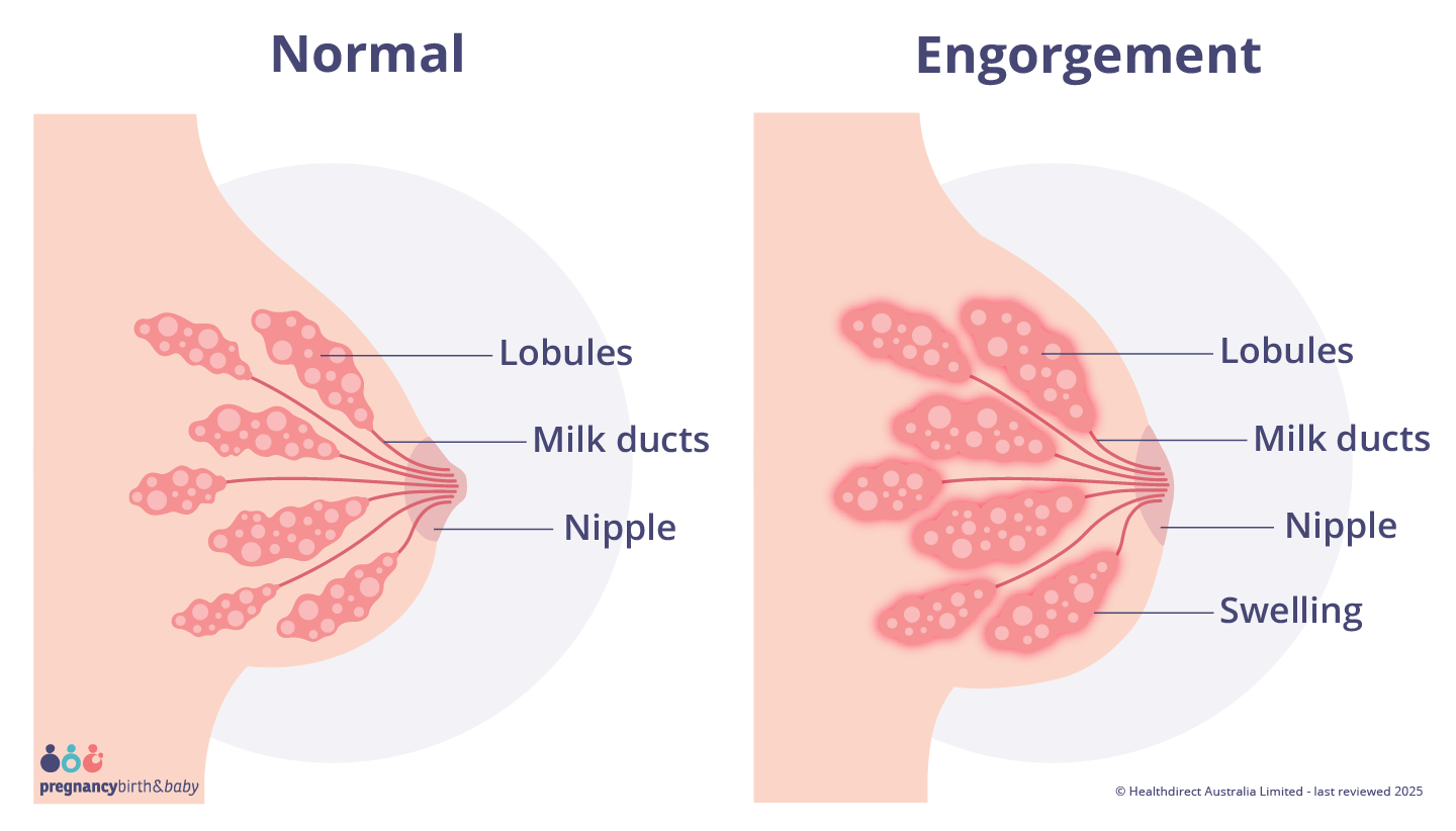 Landscape illustration of a normal breast, lobules and nipple, alongside a breast with engorgement, swollen lobules and a flat nipple.
