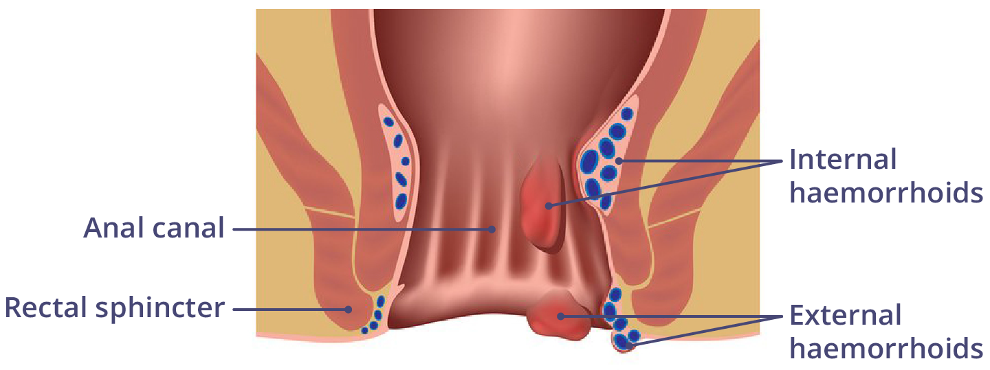 Illustration showing internal and external haemorrhoids.