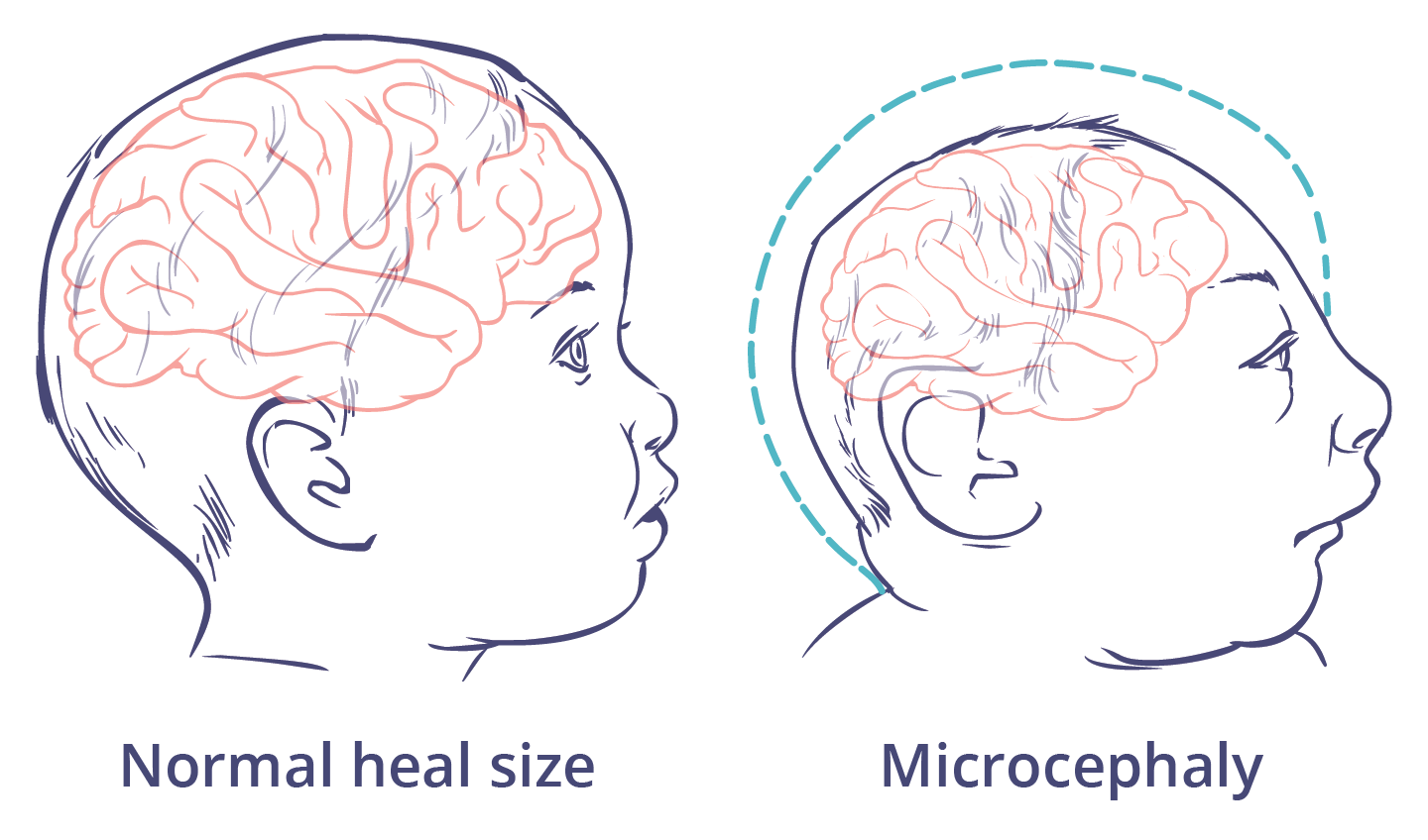 An illustration of a newborn baby with a normal head size and another newborn with microcephaly, where the head is smaller than normal.