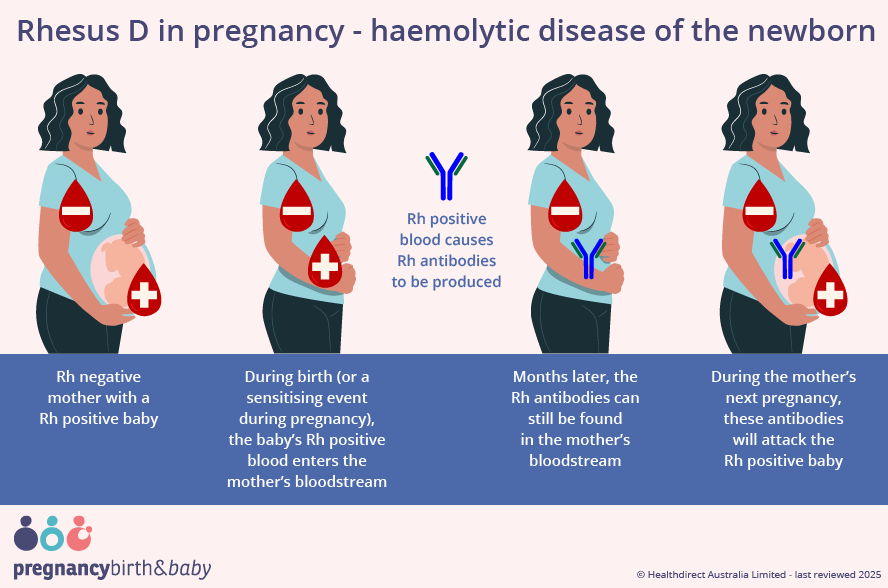 Illustration showing how haemolytic disease of the newborn can occur.