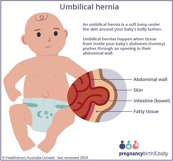 Illustration of an umbilical hernia.