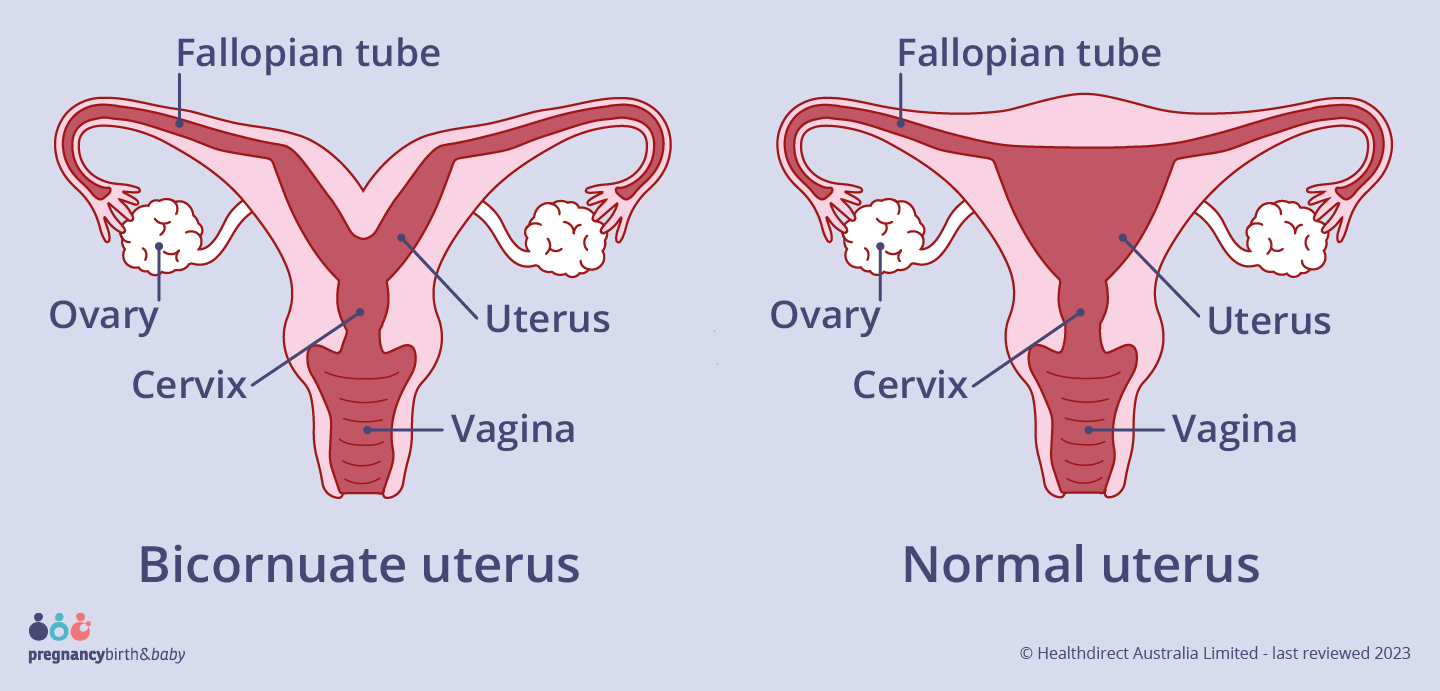 A bicornuate uterus has a deep indentation at the top of the uterus.