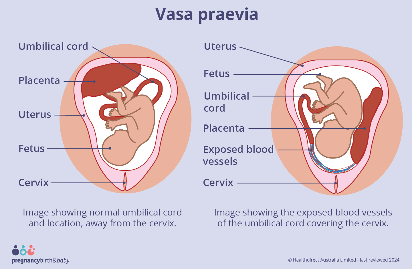 Vasa praevia