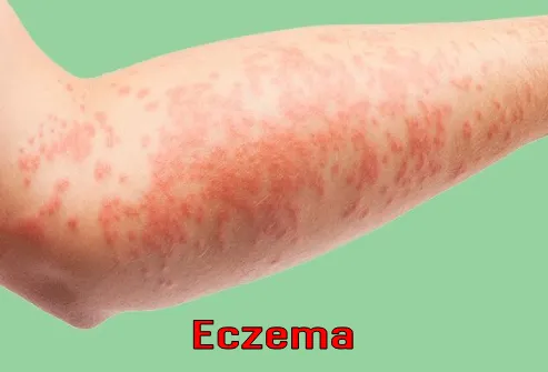 Eczema during pregnancy