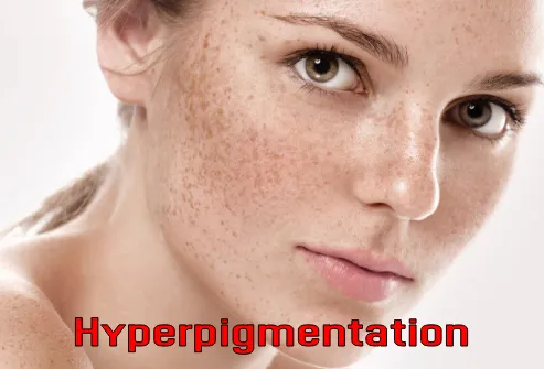 Hyperpigmentation