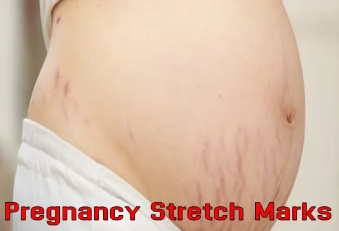 Pregnancy Stretch Marks