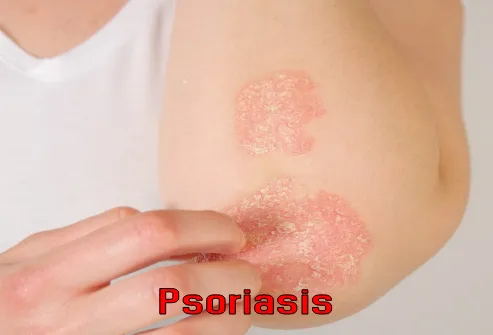 Psoriasis