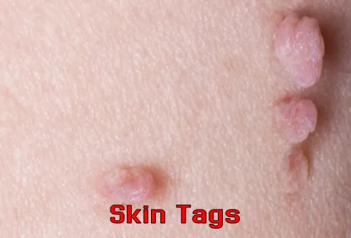 Skin Tags problems during pregnancy