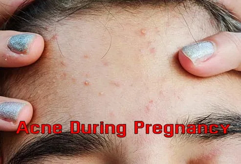 Skin problems during pregnancy Acne