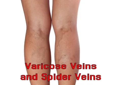 Varicose Veins and Spider Veins