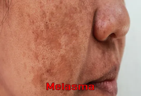 skin problems during pregnancy Melasma