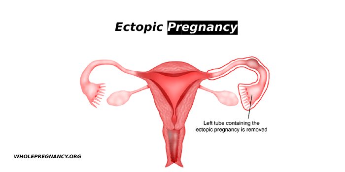 Ectopic Pregnancy